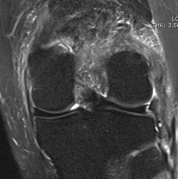 MRI Chronic Posterolateral Corner